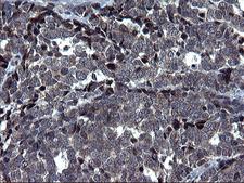 HSCB Antibody - IHC of paraffin-embedded Adenocarcinoma of Human colon tissue using anti-HSCB mouse monoclonal antibody. (Heat-induced epitope retrieval by 1 mM EDTA in 10mM Tris, pH8.5, 120°C for 3min).