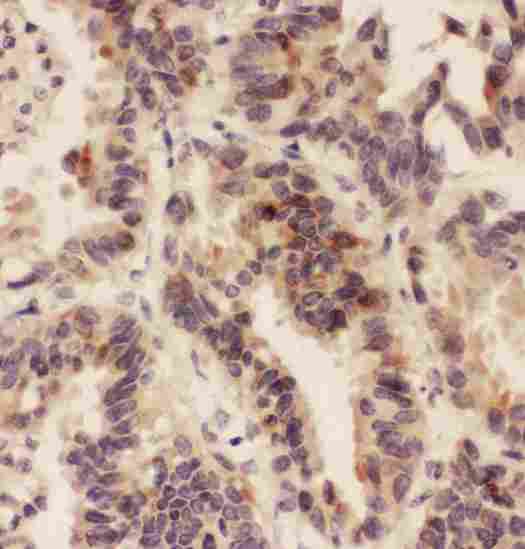 HSD11B1 / HSD11B Antibody - IHC analysis of HSD11B1 using anti-HSD11B1 antibody. HSD11B1 was detected in paraffin-embedded section of human lung cancer tissues. Heat mediated antigen retrieval was performed in citrate buffer (pH6, epitope retrieval solution) for 20 mins. The tissue section was blocked with 10% goat serum. The tissue section was then incubated with 1µg/ml rabbit anti-HSD11B1 Antibody overnight at 4°C. Biotinylated goat anti-rabbit IgG was used as secondary antibody and incubated for 30 minutes at 37°C. The tissue section was developed using Strepavidin-Biotin-Complex (SABC) with DAB as the chromogen.