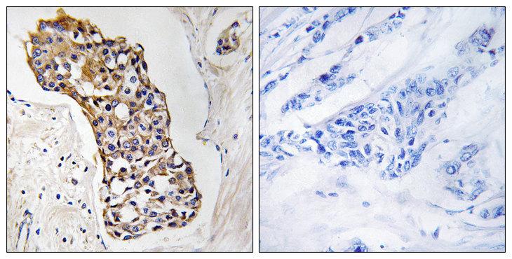 HSD11B1 / HSD11B Antibody - Peptide - + Immunohistochemistry analysis of paraffin-embedded human breast carcinoma tissue, using HSD11B1 antibody.