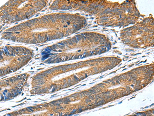 HSD11B1 / HSD11B Antibody - Immunohistochemistry of paraffin-embedded Human colorectal cancer tissue  using HSD11B1 Polyclonal Antibody at dilution of 1:70(×200)