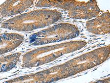 HSD11B1 / HSD11B Antibody - Immunohistochemistry of paraffin-embedded Human colorectal cancer tissue  using HSD11B1 Polyclonal Antibody at dilution of 1:70(×200)