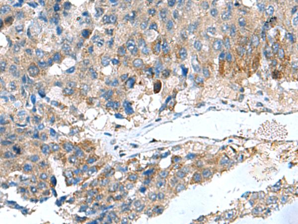 HSD11B1 / HSD11B Antibody - Immunohistochemistry of paraffin-embedded Human liver cancer tissue  using HSD11B1 Polyclonal Antibody at dilution of 1:70(×200)
