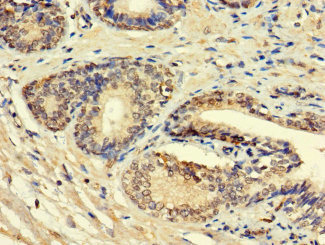 HSD11B1L Antibody - Immunohistochemistry of paraffin-embedded human prostate cancer using HSD11B1L Antibody at dilution of 1:100