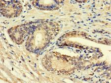HSD11B1L Antibody - Immunohistochemistry of paraffin-embedded human prostate cancer using HSD11B1L Antibody at dilution of 1:100