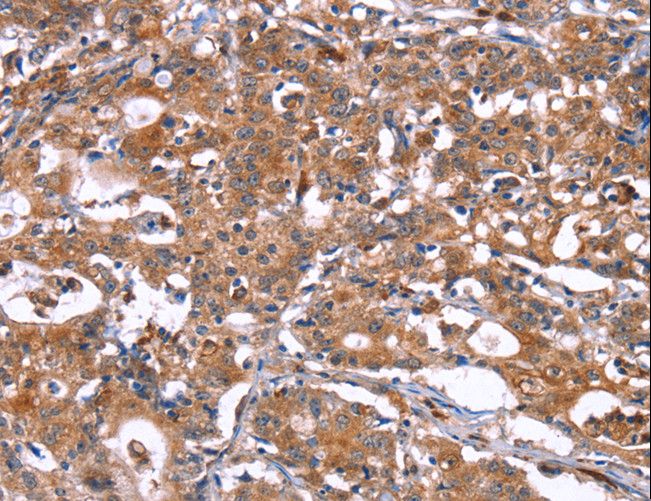 HSD17 / HSD17B1 Antibody - Immunohistochemistry of paraffin-embedded Human gastric cancer using HSD17B1 Polyclonal Antibody at dilution of 1:40.