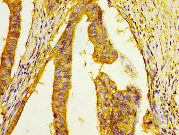 HSD17 / HSD17B1 Antibody - Immunohistochemistry image at a dilution of 1:100 and staining in paraffin-embedded human colon cancer performed on a Leica BondTM system. After dewaxing and hydration, antigen retrieval was mediated by high pressure in a citrate buffer (pH 6.0) . Section was blocked with 10% normal goat serum 30min at RT. Then primary antibody (1% BSA) was incubated at 4 °C overnight. The primary is detected by a biotinylated secondary antibody and visualized using an HRP conjugated SP system.