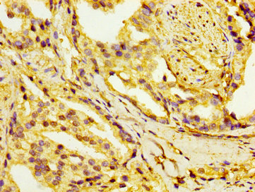 HSD17 / HSD17B1 Antibody - Immunohistochemistry image at a dilution of 1:100 and staining in paraffin-embedded human prostate cancer performed on a Leica BondTM system. After dewaxing and hydration, antigen retrieval was mediated by high pressure in a citrate buffer (pH 6.0) . Section was blocked with 10% normal goat serum 30min at RT. Then primary antibody (1% BSA) was incubated at 4 °C overnight. The primary is detected by a biotinylated secondary antibody and visualized using an HRP conjugated SP system.