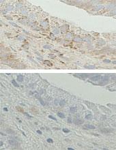 HSD17B10 / HADH2 Antibody - Immunohistochemistry on Formalin-fixed and paraffin-embedded human prostate tissue. (Top)Coloration with the Anti-ABAD antibody at a 1:20 concentration. (Bottom)Antibody adsorbed to the antigen (peptide), negative control.Disappearance of cytoplasmic staining indicating the antibody is specific. Data and protocol courtesy of Marie-Helene Levesque, Centre de Recherche du CHUL, Canada.