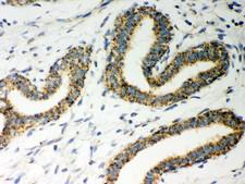 HSD17B10 / HADH2 Antibody - ERAB antibody IHC-paraffin: Human Mammary Cancer Tissue.