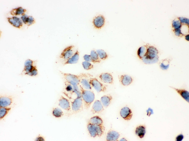 HSD17B10 / HADH2 Antibody - IHC analysis of ERAB using anti-ERAB antibody. ERAB was detected in immunocytochemical section of MCF-7 cell. Heat mediated antigen retrieval was performed in citrate buffer (pH6, epitope retrieval solution) for 20 mins. The tissue section was blocked with 10% goat serum. The tissue section was then incubated with 1µg/ml rabbit anti-ERAB Antibody overnight at 4°C. Biotinylated goat anti-rabbit IgG was used as secondary antibody and incubated for 30 minutes at 37°C. The tissue section was developed using Strepavidin-Biotin-Complex (SABC) with DAB as the chromogen.