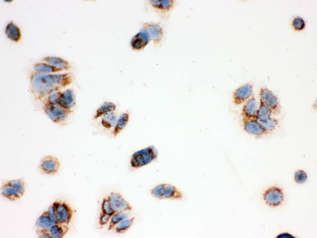 HSD17B10 / HADH2 Antibody - IHC analysis of ERAB using anti-ERAB antibody. ERAB was detected in immunocytochemical section of MCF-7 cell. Heat mediated antigen retrieval was performed in citrate buffer (pH6, epitope retrieval solution) for 20 mins. The tissue section was blocked with 10% goat serum. The tissue section was then incubated with 1µg/ml rabbit anti-ERAB Antibody overnight at 4°C. Biotinylated goat anti-rabbit IgG was used as secondary antibody and incubated for 30 minutes at 37°C. The tissue section was developed using Strepavidin-Biotin-Complex (SABC) with DAB as the chromogen.