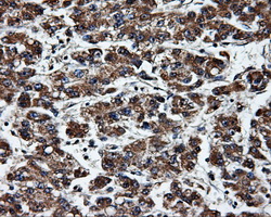 HSD17B10 / HADH2 Antibody - IHC of paraffin-embedded Carcinoma of liver tissue using anti-HSD17B10 mouse monoclonal antibody. (Dilution 1:50).