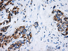 HSD17B10 / HADH2 Antibody - IHC of paraffin-embedded Adenocarcinoma of breast tissue using anti-HSD17B10 mouse monoclonal antibody. (Dilution 1:50).