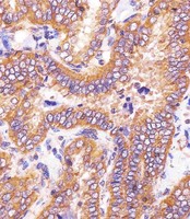 HSD17B10 / HADH2 Antibody - HSD17B10 Antibody (Center) staining HSD17B10 in human thyroid carcinoma sections by Immunohistochemistry (IHC-P - paraformaldehyde-fixed, paraffin-embedded sections). Tissue was fixed with formaldehyde and blocked with 3% BSA for 0. 5 hour at room temperature; antigen retrieval was by heat mediation with a citrate buffer (pH6). Samples were incubated with primary antibody (1/25) for 1 hours at 37°C. A undiluted biotinylated goat polyvalent antibody was used as the secondary antibody.