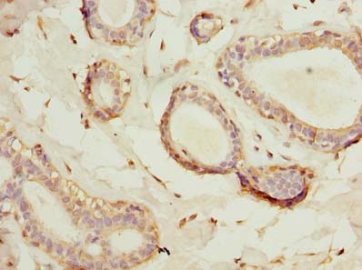 HSD17B12 Antibody - Immunohistochemistry of paraffin-embedded human breast cancer using antibody at dilution of 1:100.