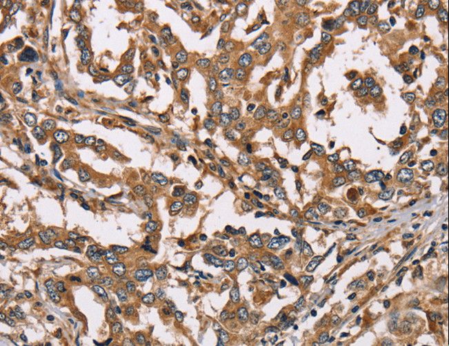HSD17B12 Antibody - Immunohistochemistry of paraffin-embedded Human liver cancer using HSD17B12 Polyclonal Antibody at dilution of 1:40.