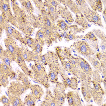 HSD17B13 Antibody - Immunohistochemistry of paraffin-embedded Human liver injury tissue.