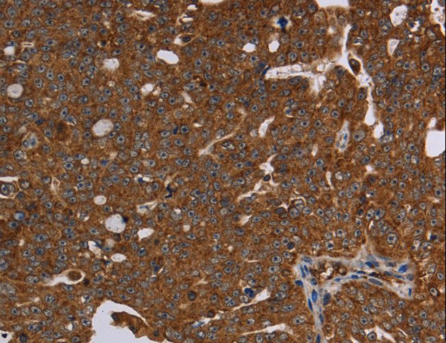 HSD17B13 Antibody - Immunohistochemistry of paraffin-embedded Human colon cancer using HSD17B13 Polyclonal Antibody at dilution of 1:30.