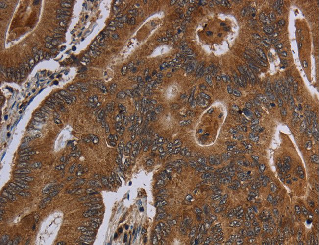 HSD17B13 Antibody - Immunohistochemistry of paraffin-embedded Human colon cancer using HSD17B13 Polyclonal Antibody at dilution of 1:30.
