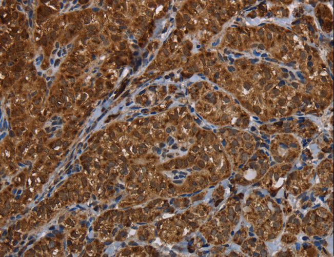 HSD17B13 Antibody - Immunohistochemistry of paraffin-embedded Human thyroid cancer using HSD17B13 Polyclonal Antibody at dilution of 1:30.