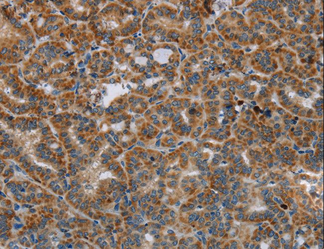 HSD17B14 Antibody - Immunohistochemistry of paraffin-embedded Human liver cancer using HSD17B14 Polyclonal Antibody at dilution of 1:40.