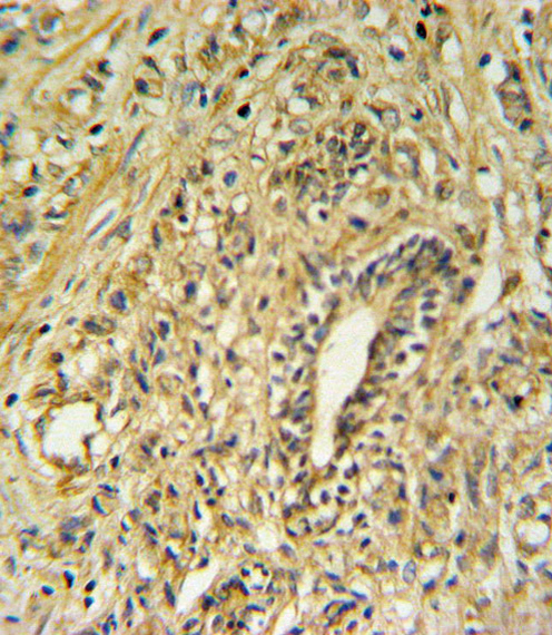 HSD17B2 Antibody - HSD17B2 Antibody IHC of formalin-fixed and paraffin-embedded human prostate carcinoma followed by peroxidase-conjugated secondary antibody and DAB staining.
