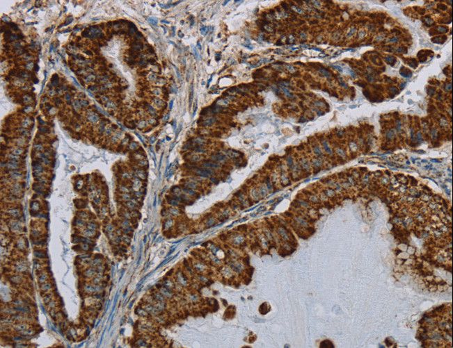 HSD17B2 Antibody - Immunohistochemistry of paraffin-embedded Human esophagus cancer using HSD17B2 Polyclonal Antibody at dilution of 1:50.
