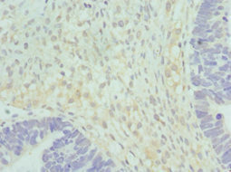 HSD17B2 Antibody - Immunohistochemistry of paraffin-embedded human ovarian cancer at dilution 1:100