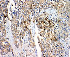 HSD17B4 Antibody - HSD17B4 antibody. IHC(P): Human Lung Cancer Tissue.