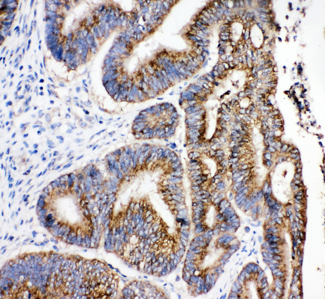 HSD17B4 Antibody - HSD17B4 antibody. IHC(P): Human Intestinal Cancer Tissue.
