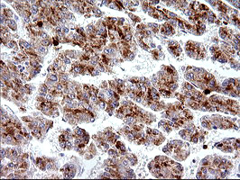 HSD17B4 Antibody - IHC of paraffin-embedded Carcinoma of Human liver tissue using anti-HSD17B4 mouse monoclonal antibody. (Heat-induced epitope retrieval by 10mM citric buffer, pH6.0, 120°C for 3min).