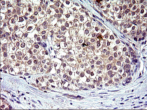 HSD17B4 Antibody - IHC of paraffin-embedded Carcinoma of Human liver tissue using anti-HSD17B4 mouse monoclonal antibody. (Heat-induced epitope retrieval by 10mM citric buffer, pH6.0, 120°C for 3min).