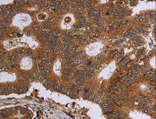 HSD17B4 Antibody - Immunohistochemistry of paraffin-embedded Human colon cancer using HSD17B4 Polyclonal Antibody at dilution of 1:30.