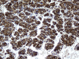 HSD17B8 / RING2 Antibody - IHC of paraffin-embedded Carcinoma of Human liver tissue using anti-HSD17B8 mouse monoclonal antibody. (Heat-induced epitope retrieval by 10mM citric buffer, pH6.0, 100C for 10min).