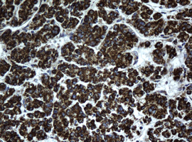 HSD17B8 / RING2 Antibody - IHC of paraffin-embedded Carcinoma of Human liver tissue using anti-HSD17B8 mouse monoclonal antibody.