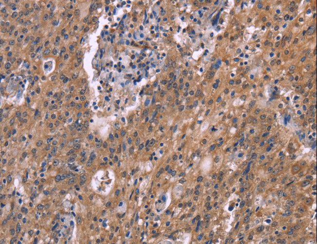 HSD2 / HSD11B2 Antibody - Immunohistochemistry of paraffin-embedded Human liver cancer using HSD11B2 Polyclonal Antibody at dilution of 1:50.