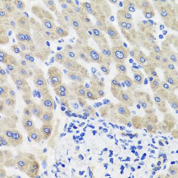 HSD2 / HSD11B2 Antibody - Immunohistochemistry of paraffin-embedded Human liver damage using HSD11B2 Polyclonal Antibody at dilution of 1:100 (40x lens).