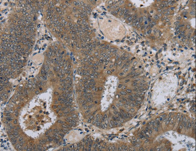 HSD3B1 Antibody - Immunohistochemistry of paraffin-embedded Human colon cancer using HSD3B1 Polyclonal Antibody at dilution of 1:40.