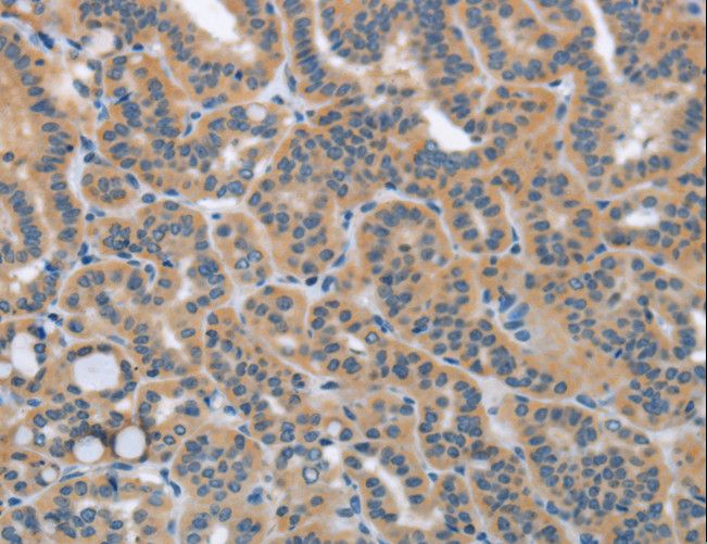 HSD3B1 Antibody - Immunohistochemistry of paraffin-embedded Human thyroid cancer using HSD3B1 Polyclonal Antibody at dilution of 1:40.