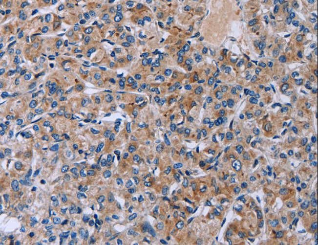HSD3B2 Antibody - Immunohistochemistry of paraffin-embedded Human prostate cancer using HSD3B2 Polyclonal Antibody at dilution of 1:50.