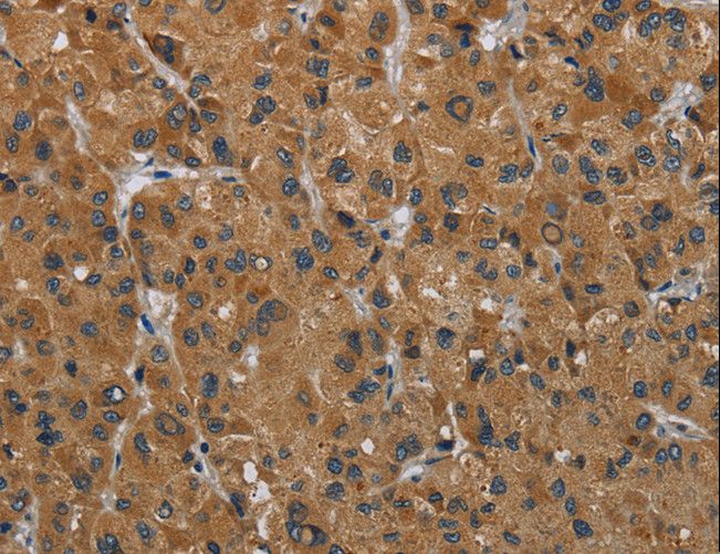 HSD3B7 Antibody - Immunohistochemistry of paraffin-embedded Human liver cancer using HSD3B7 Polyclonal Antibody at dilution of 1:40.