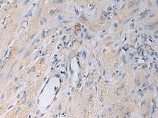 HSDL2 Antibody - Immunohistochemistry of paraffin-embedded Human gastric cancer tissue  using HSDL2 Polyclonal Antibody at dilution of 1:55(×200)