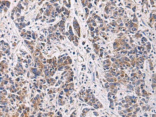 HSDL2 Antibody - Immunohistochemistry of paraffin-embedded Human colorectal cancer tissue  using HSDL2 Polyclonal Antibody at dilution of 1:80(×200)