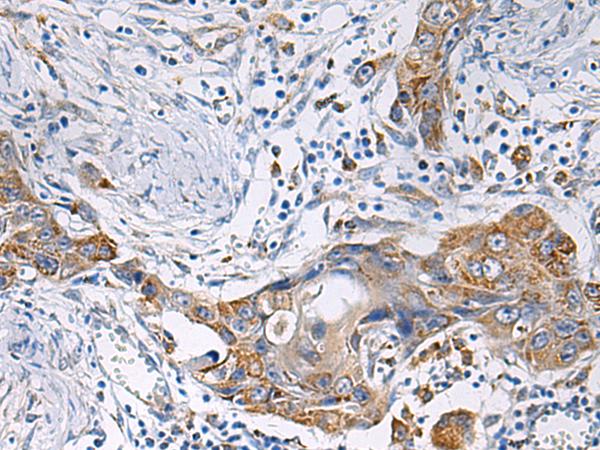 HSDL2 Antibody - Immunohistochemistry of paraffin-embedded Human esophagus cancer tissue  using HSDL2 Polyclonal Antibody at dilution of 1:80(×200)