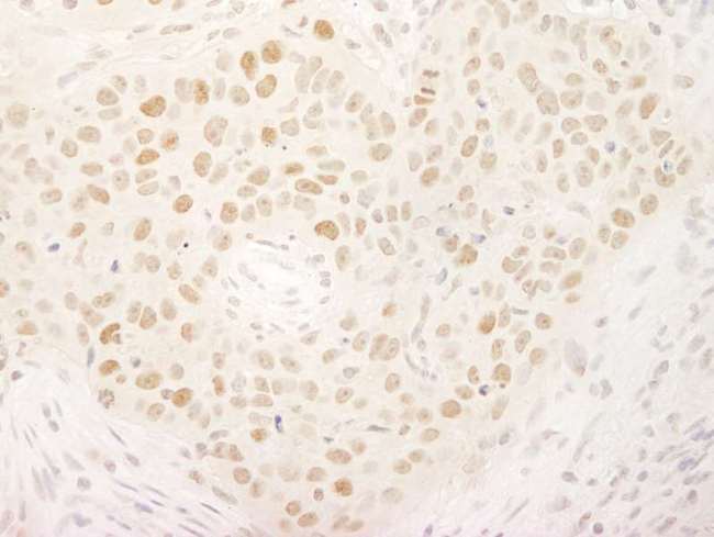 HSET / KIFC1 Antibody - Detection of Human KIFC1/MKLP2 by Immunohistochemistry. Sample: FFPE section of human ovarian carcinoma. Antibody: Affinity purified rabbit anti-KIFC1/MKLP2 used at a dilution of 1:5000 (0.2 ug/ml). Detection: DAB.