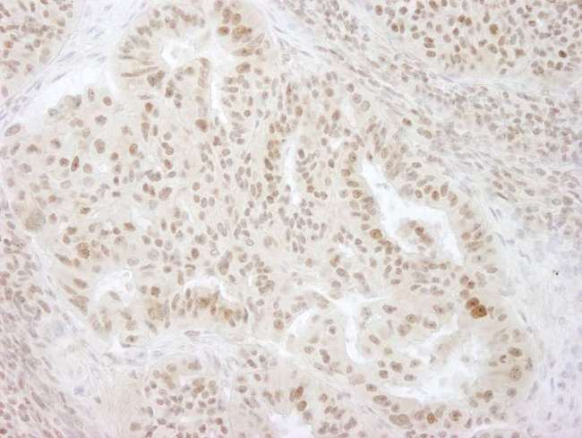 HSET / KIFC1 Antibody - Detection of Human KIFC1 by Immunohistochemistry. Sample: FFPE section of human ovarian carcinoma. Antibody: Affinity purified rabbit anti-KIFC1 used at a dilution of 1:250. Epitope Retrieval Buffer-High pH (IHC-101J) was substituted for Epitope Retrieval Buffer-Reduced pH.
