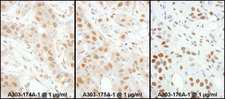 HSF1 Antibody - Detection of Human HSF1 by Immunohistochemistry. Samples: FFPE sections of human breast carcinoma. Antibody: Affinity purified rabbit anti-HSF1 used at a dilution of 1:1000. Detection: DAB.