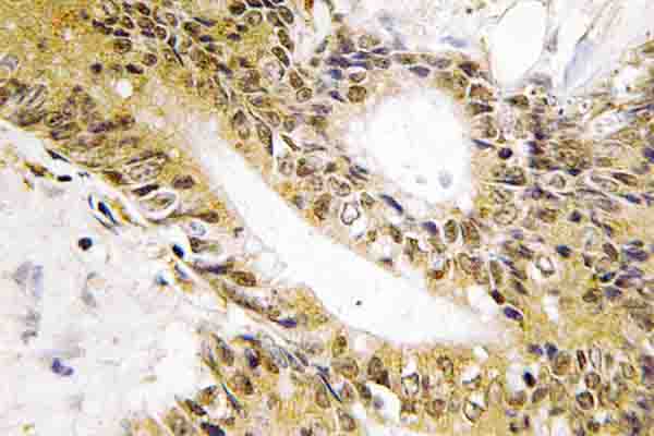 HSF1 Antibody - IHC of HSF1 (D135) pAb in paraffin-embedded human colon carcinoma tissue.