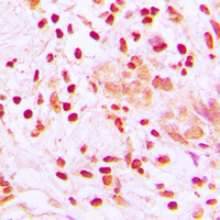 HSF1 Antibody - Immunohistochemical analysis of HSF1 staining in human lung cancer formalin fixed paraffin embedded tissue section. The section was pre-treated using heat mediated antigen retrieval with sodium citrate buffer (pH 6.0). The section was then incubated with the antibody at room temperature and detected using an HRP conjugated compact polymer system. DAB was used as the chromogen. The section was then counterstained with hematoxylin and mounted with DPX.