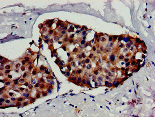 HSF1 Antibody - Immunohistochemistry image of paraffin-embedded human breast cancer at a dilution of 1:100